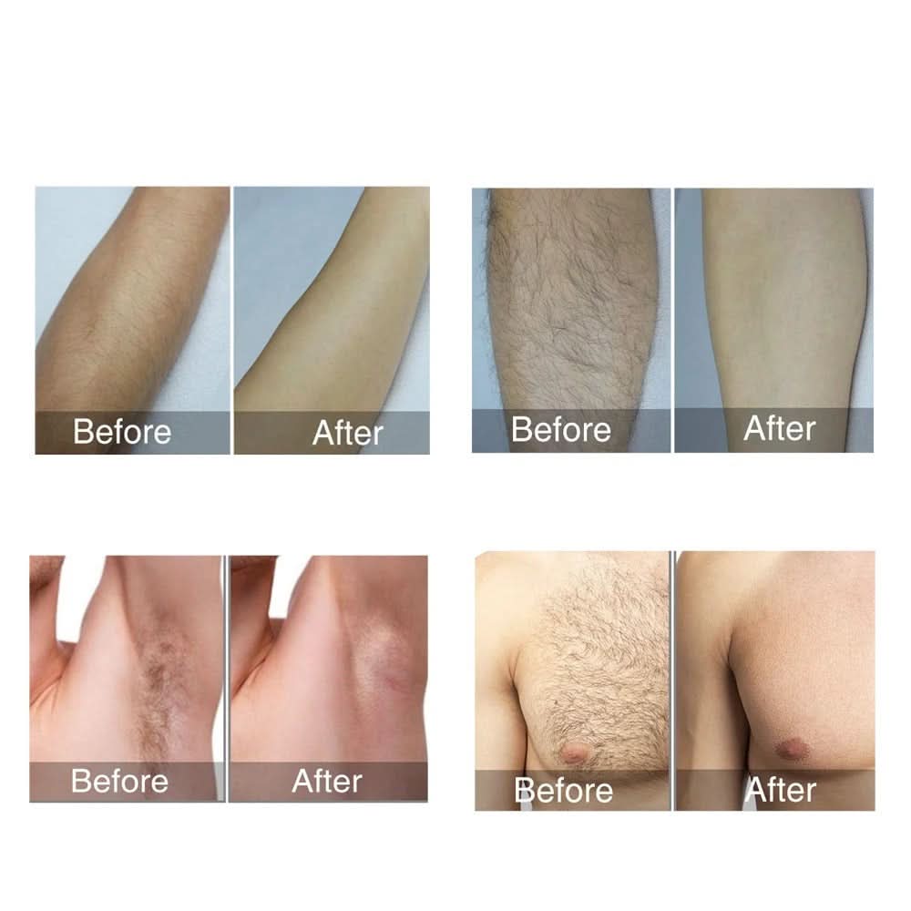 SilkSmooth™ – Smertefri laserhårfjerning for langvarig glatt hud hjemme